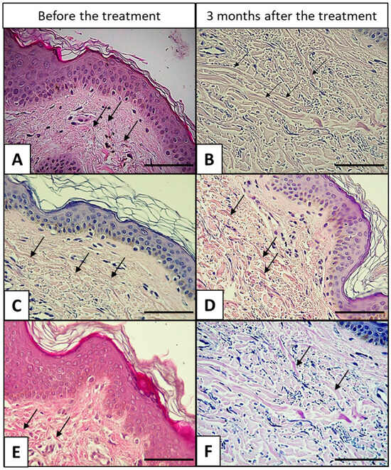 Histologisches Hautbild nach Mesotherapie mit Schneckenschleim – Kollagenfasern H&E 40x