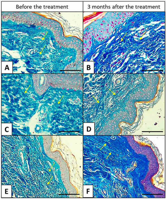 Histologisches Hautbild der Haut vor und nach Mesotherapie mit Schneckenschleim – Kollagenfasern, Mallory-Trichrom-Färbung, 40x
