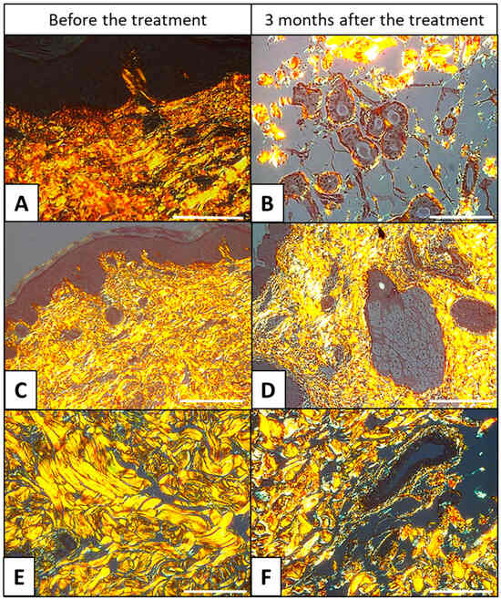 Histologisches Hautbild der Haut nach Mesotherapie mit Schneckenschleim – Kollagen, Picro-Sirius-Red-Färbung, 40x