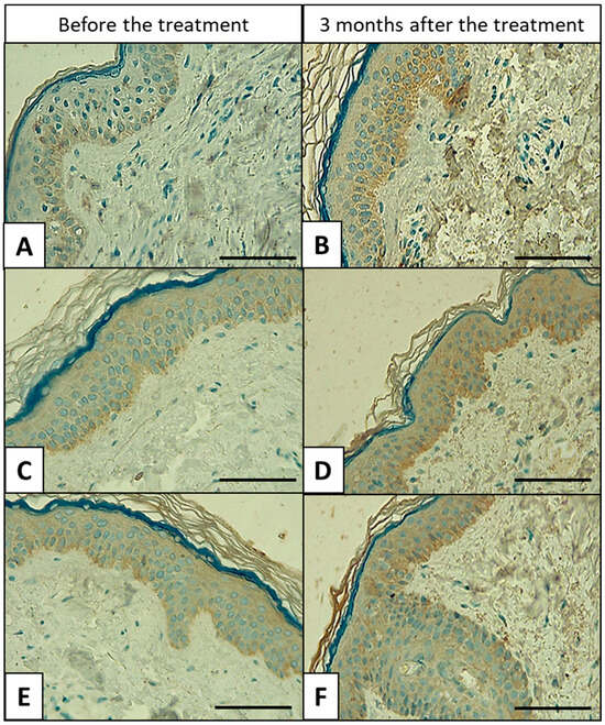 Ki67 Immunhistochemie der Haut vor und nach Microneedling-Mesotherapie mit Schneckenschleim 98,2 %, Vergleich mit NaCl, histologische Analyse der Epidermis, 40× Mikroskopie